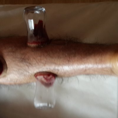 Bacak Ağrıları