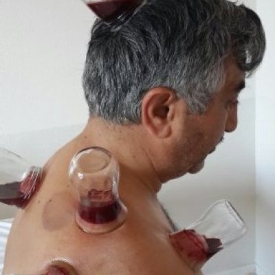 Kolda Sinir Sıkışması