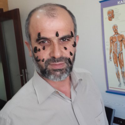Koruyucu Sülük Uygulaması ve Botoks
